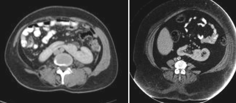 Figura 9. As duas imagens da tomografia computadorizada em secção transversal do abdome mostram os rins fundidos na região central da imagem.