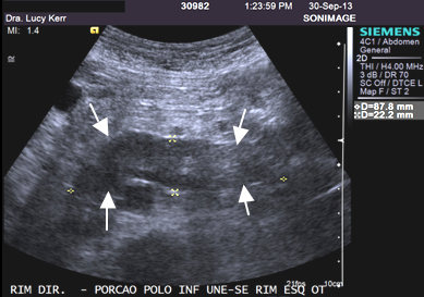 Figura 10A,B. Istmo do rim em ferradura. Corte ultrassonográfico transversal no plano pré emergência das artérias ilíacas (A, à esquerda), mostra o istmo dos rins em ferradura (setas).